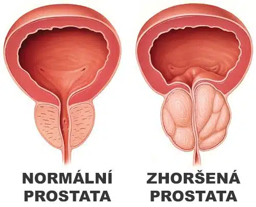 Ukázka normální a zhoršené prostaty
